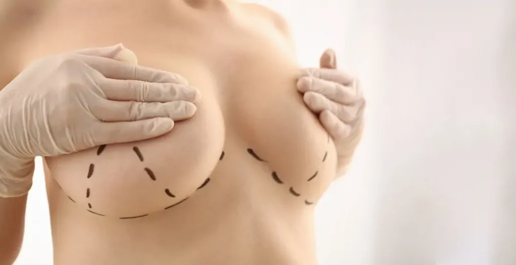 Breast-Lift-Tijuana-Mexico-Mastopexy-minutes-from-San-Diego-1030x529