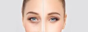 Chirurgie des paupières inférieures à Paris