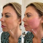 Endolift Treatments in Dubai for Precision Facial Contouring