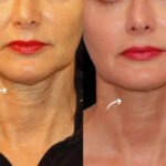 sculptra in dubai