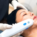 Ultherapy Treatment