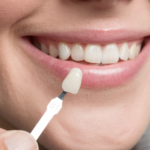 dental veneers in Dubai