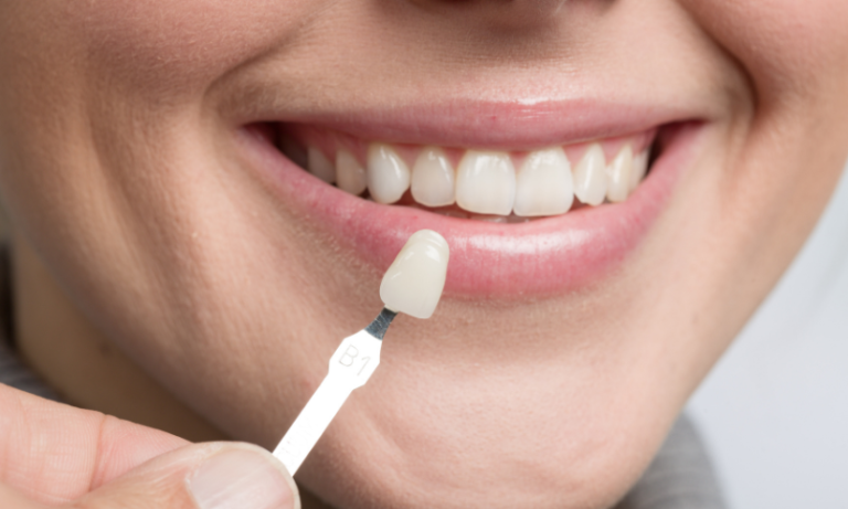 dental veneers in Dubai