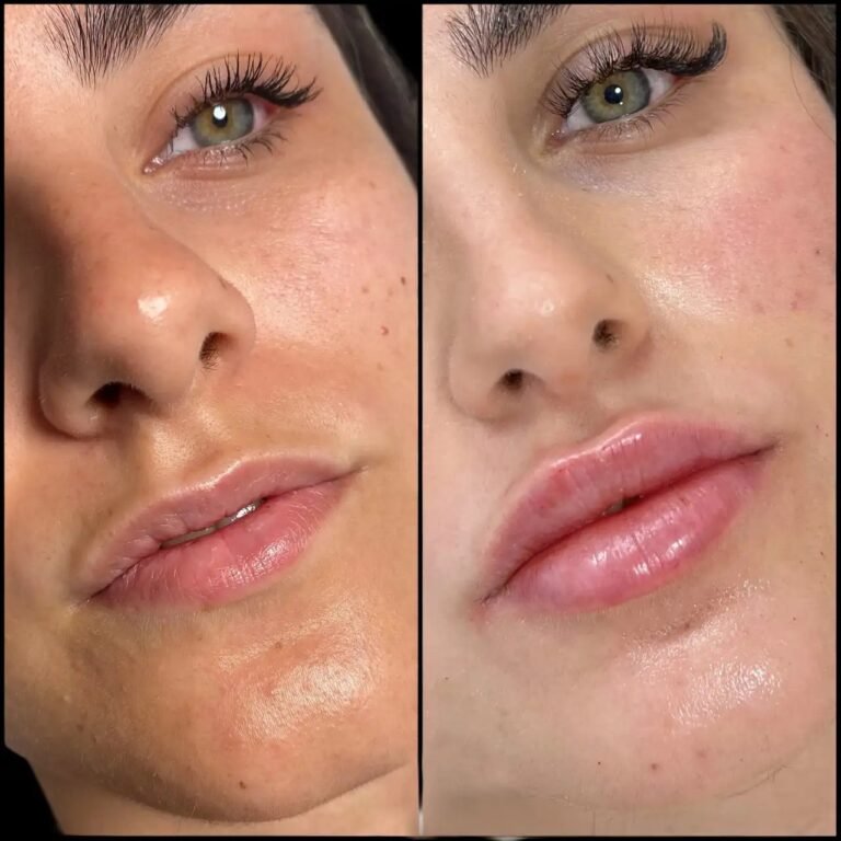 Dermal Fillers Injection in Dubai