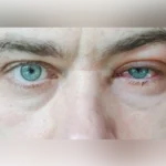 Natural Home Remedies for Blepharitis featuring warm compresses and gentle eyelid care for irritation relief.
