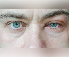 Natural Home Remedies for Blepharitis featuring warm compresses and gentle eyelid care for irritation relief.