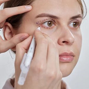 Upper Blepharoplasty in Dubai