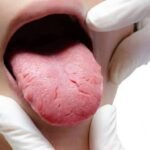 Natural Burning Mouth Syndrome Supplements