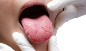 Natural Burning Mouth Syndrome Supplements