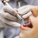 When Is Gum Surgery Recommended