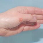 - Bullous pemphigoid natural remedies for skin support The article specifically discusses five remedies: honey, chamomile tea, peppermint oil, vitamin C, and turmeric.
