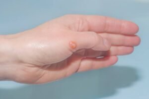 - Bullous pemphigoid natural remedies for skin support The article specifically discusses five remedies: honey, chamomile tea, peppermint oil, vitamin C, and turmeric.