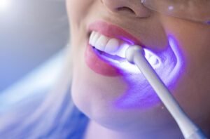 teeth-whitening-services